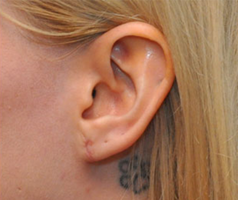 repaired earlobe